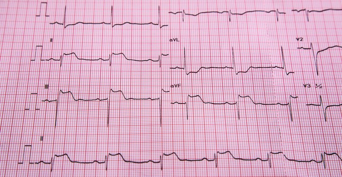 EKG - STEMI - ST yükselmesi ve kalp kası enfarktüsü belirtileri