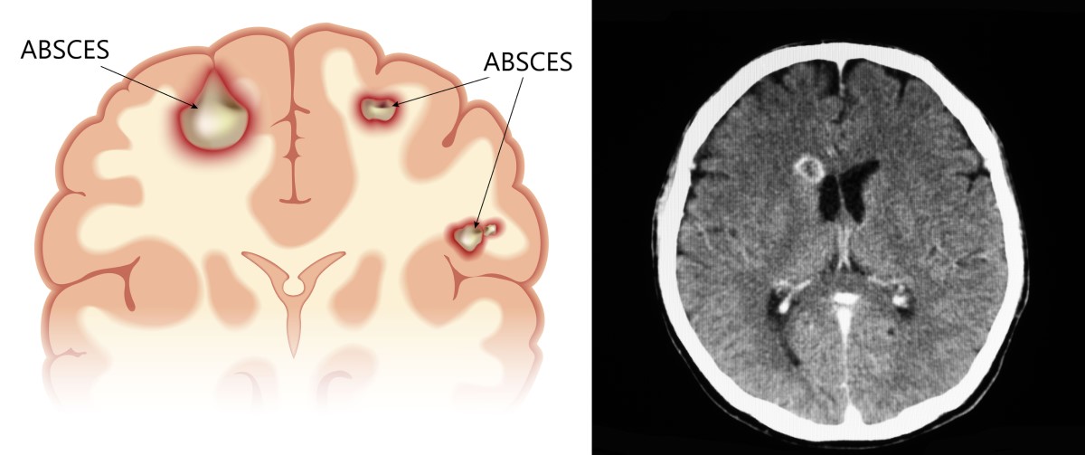 Beyin apsesinin anatomik görünümleri ve BT taramaları