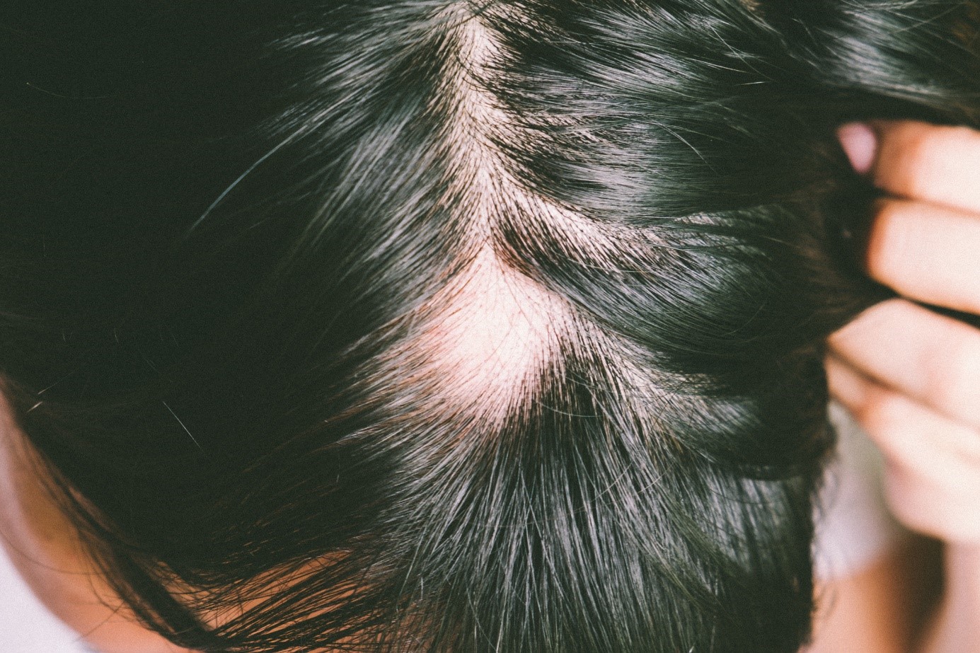 Alopesi, baş, siyah saç, aşırı saç dökülmesi durumu