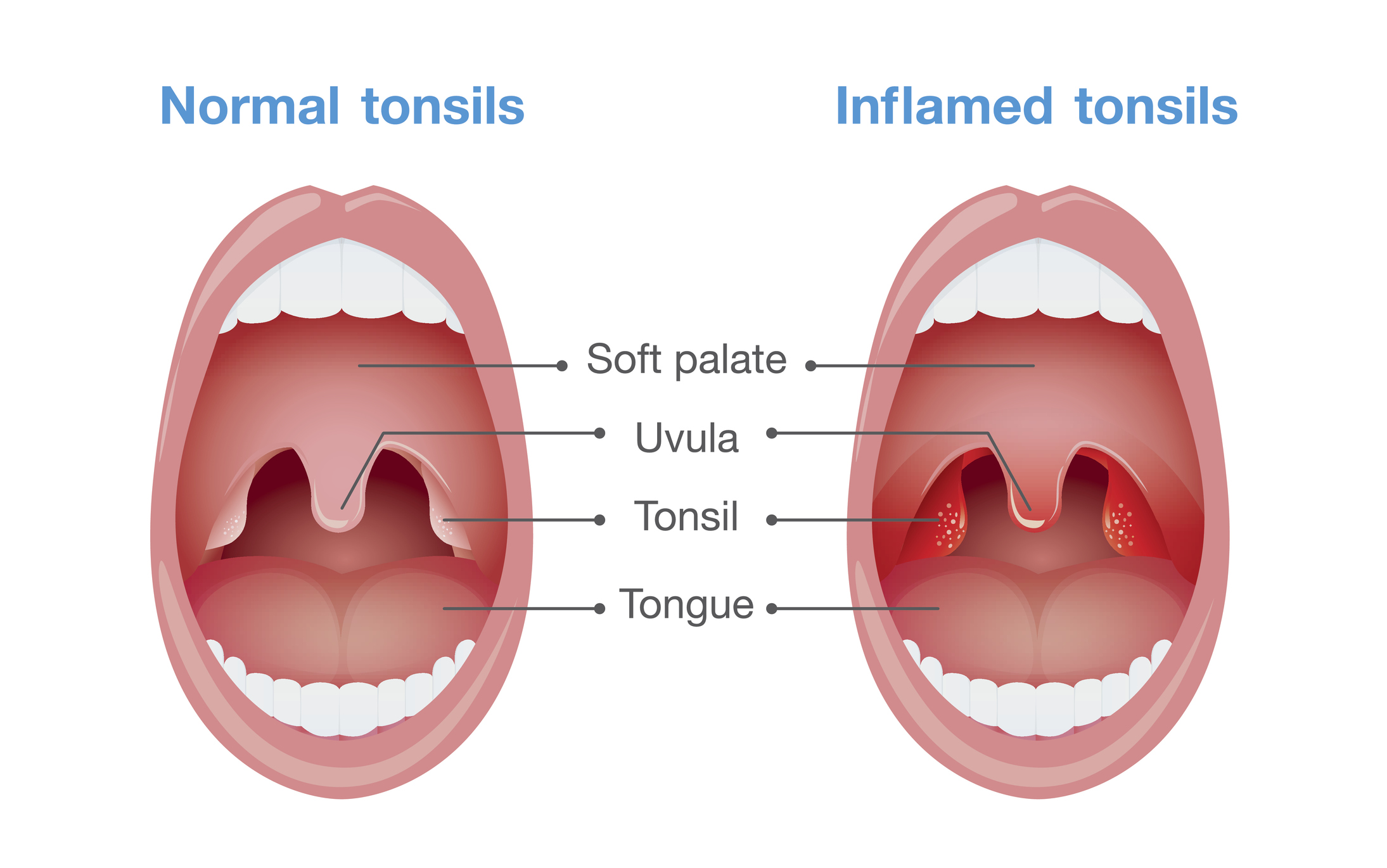 Angina - bademcik iltihabı