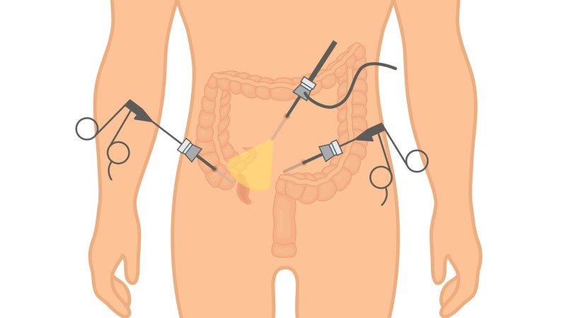 Apandisitte laparoskopinin model gösterimi