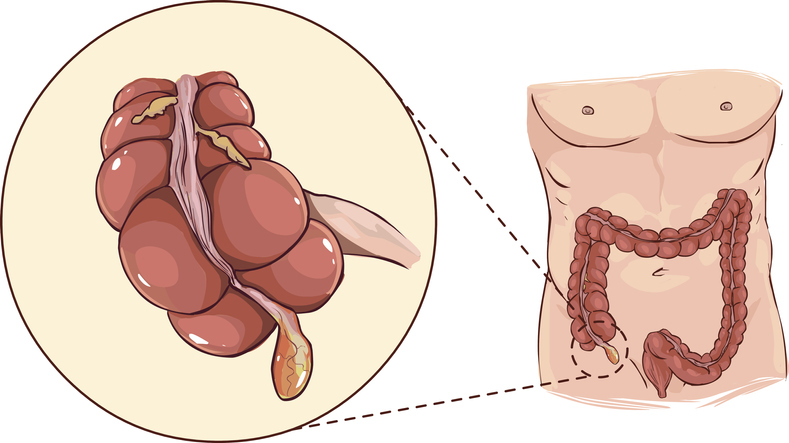 Apendiks - kolonun başlangıcındaki anatomik temsil