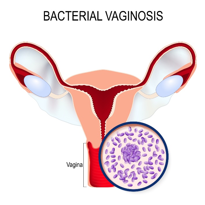 Bakteriyel vajinozis ve Gardnerella vaginalis aşırı çoğalması