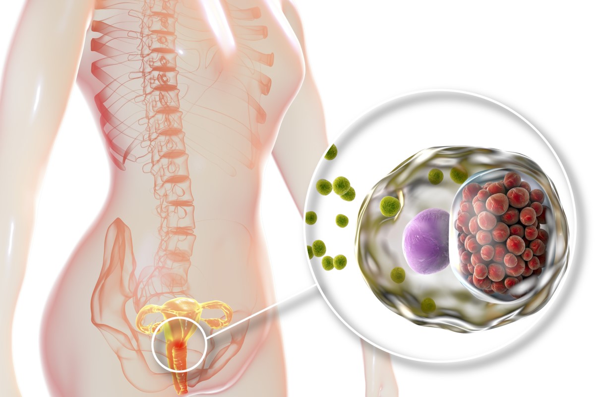 Enfeksiyon rahim ağzını istila etmiştir - kadın üreme sisteminin anatomik gösterimi