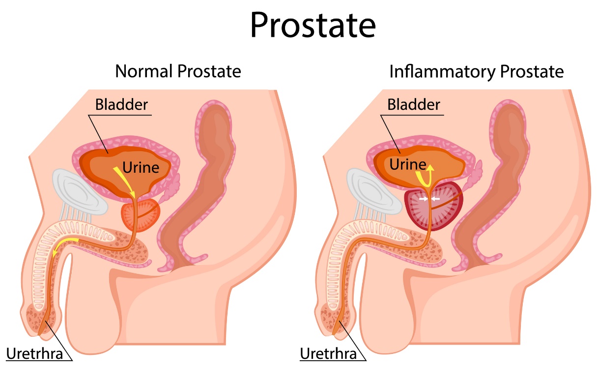 Sol: fizyolojik prostat. Sağ: büyümüş prostat. Mesanenin altında bulunur. Mesane, idrar, üretra.