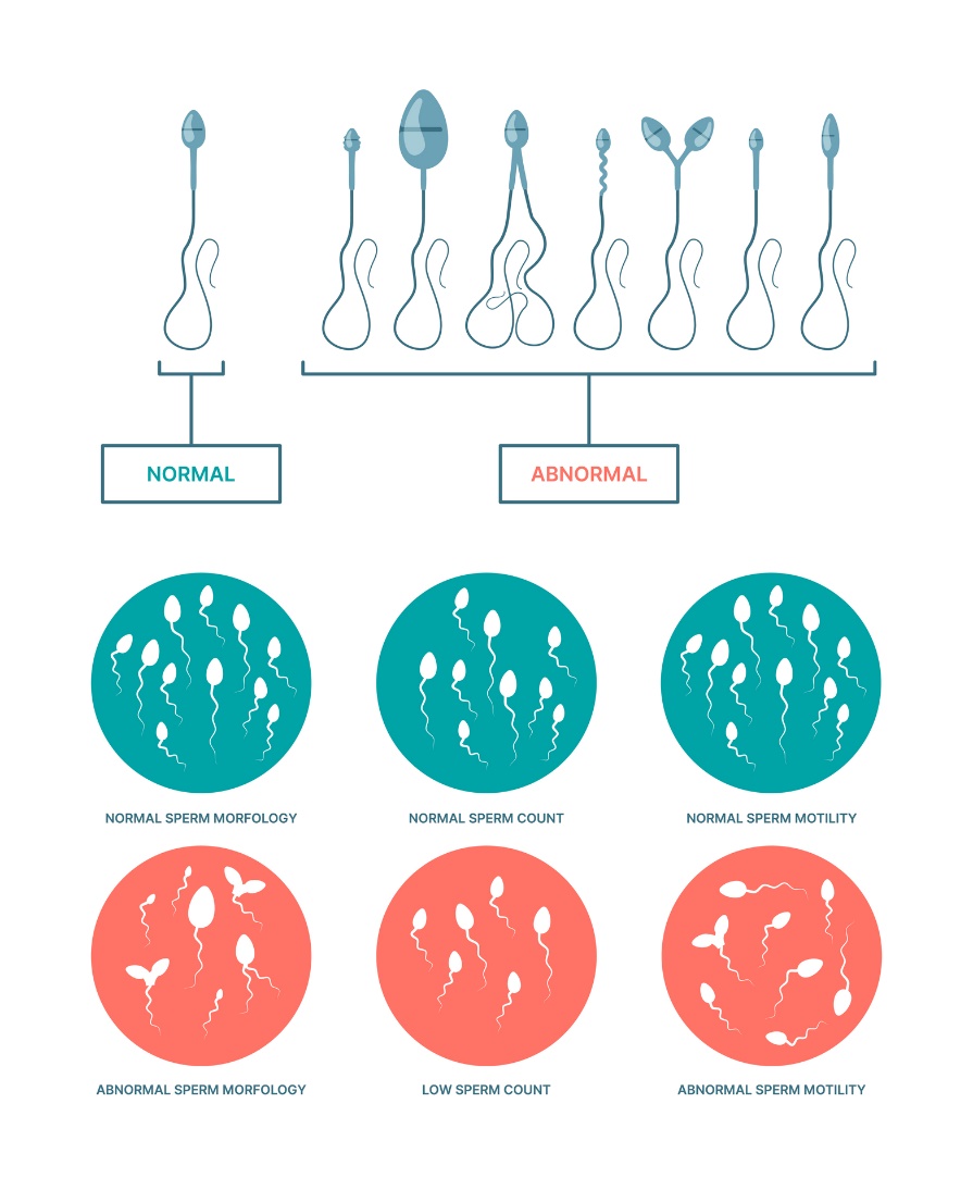 Spermatozoanın fizyolojik ve anormal durumu Sperm morfolojisi, sayısı ve hareketliliği