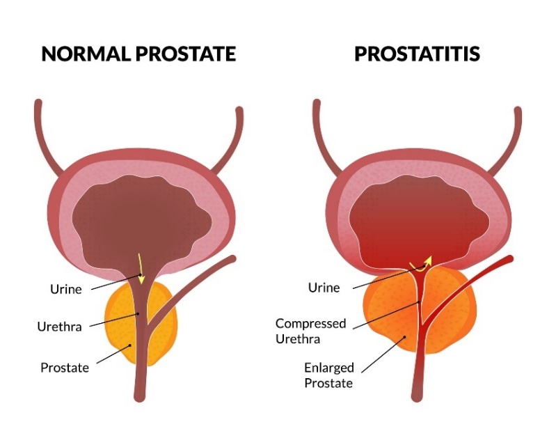 Prostatın fizyolojik durumu ve prostatit