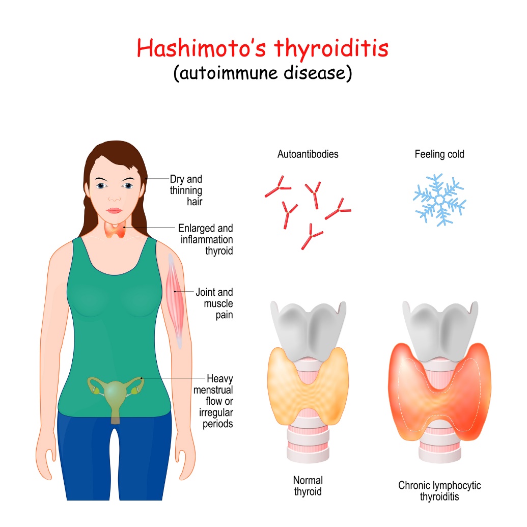 Hashimoto tiroiditi ve klinik semptomlar