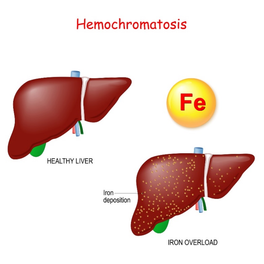 Hemokromatoz: aşırı demir (Fe) birikimi ile karaciğer fizyolojisi ve patolojisi