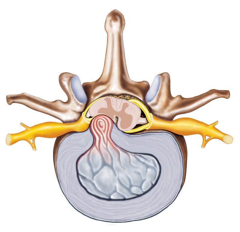 Fıtıklaşmış disk - anatomik gösterim