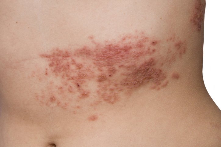 Karın bölgesinde herpes zoster