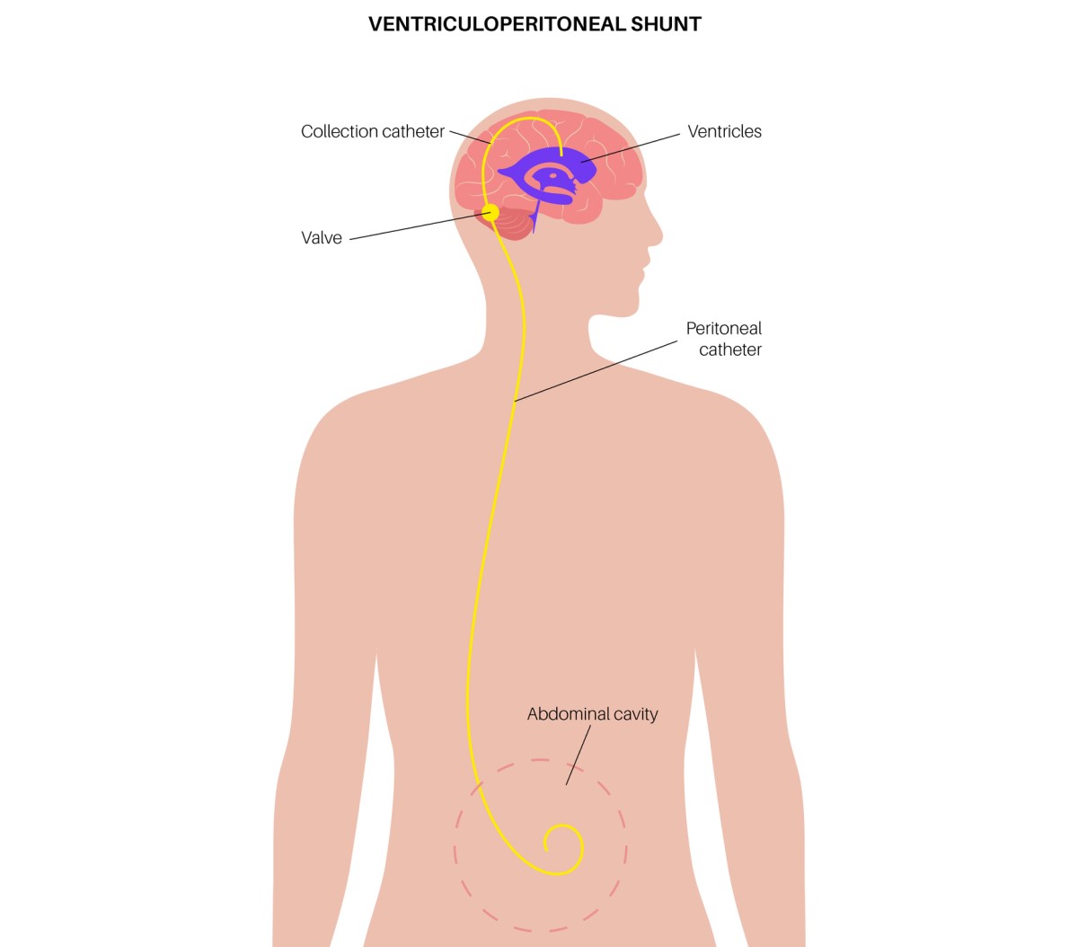 Beyindeki fazla sıvıyı karın boşluğuna boşaltan ventrikülo-abdominal şantın gösterimi.