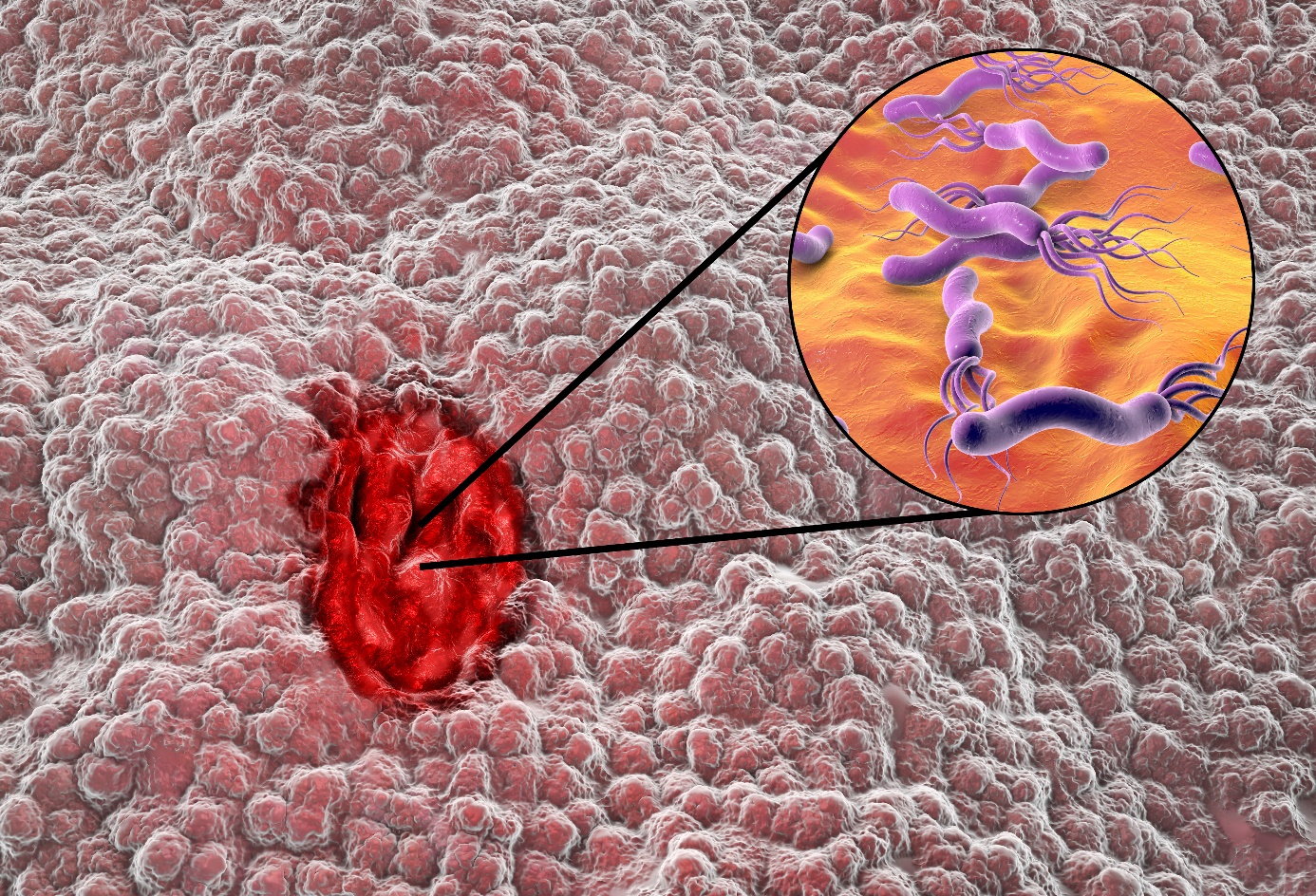 Helicobacter pylori enfeksiyonu