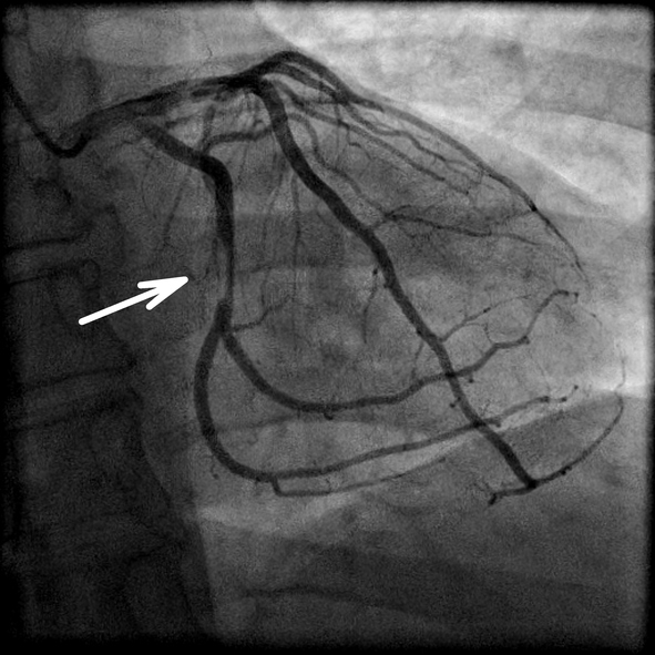 Koronarografi ve kalp arterinin daralması