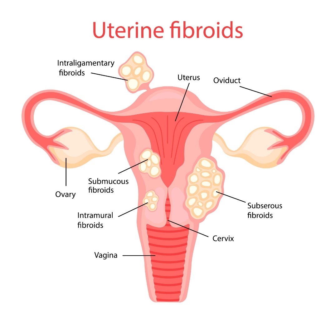 Uterin fibroidler (rahim fibroidleri)