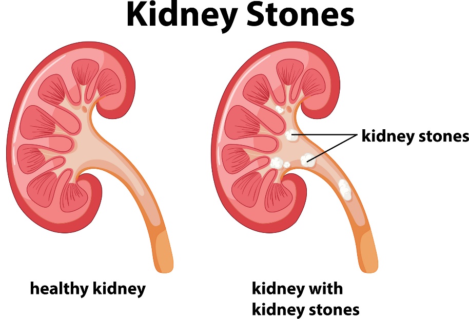 Böbrek taşları