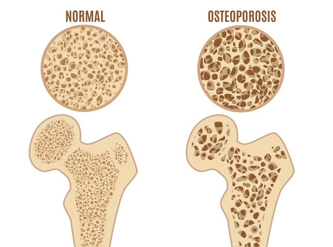 Uyluk kemiği osteoporozu