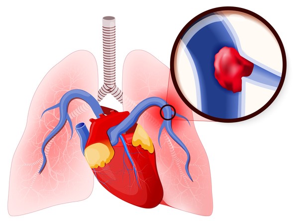 Pulmoner emboli, pulmoner arterin bir kan pıhtısı tarafından kapatılması