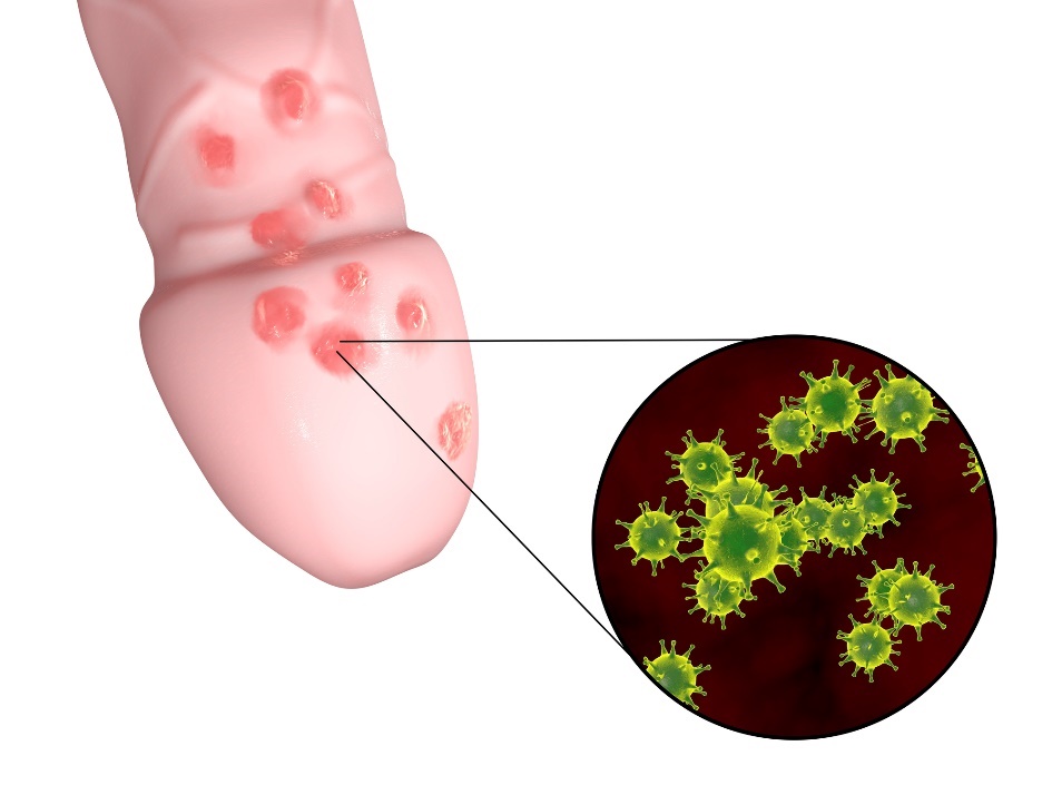 Erkeklik organının genital bölgesinde küçük genital herpes kabarcıklarının oluşması.