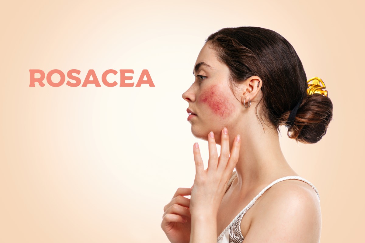 Yandan kadın, rosacealı yüz - rosacea