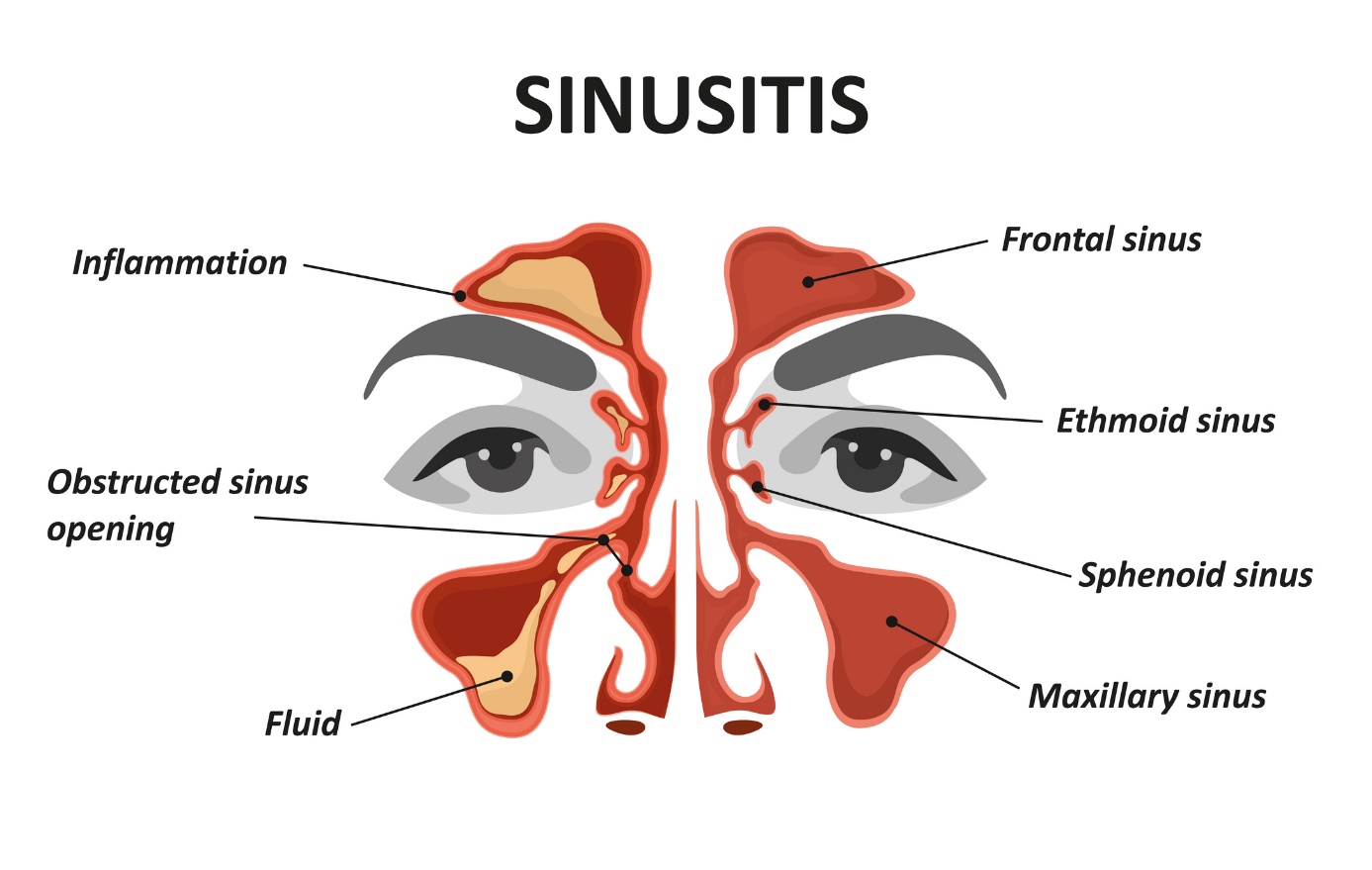 Sinüzit ve sinüzitin animasyonlu modeli/görüntüsü