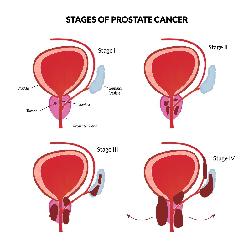 Prostat kanserinin 4 temel aşaması