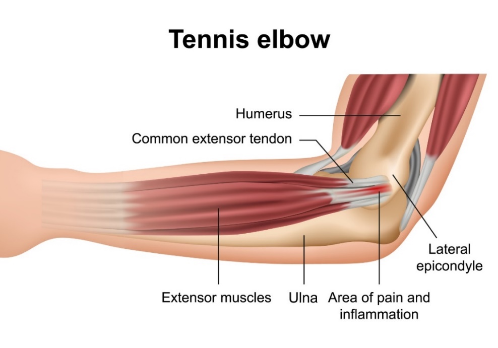 Tenisçi dirseği (lateral epikondilit): dirsek eklemi kemikleri, ön kol kaslarının ekstansörleri, lateral epikondil ve birincil ağrı bölgesi.