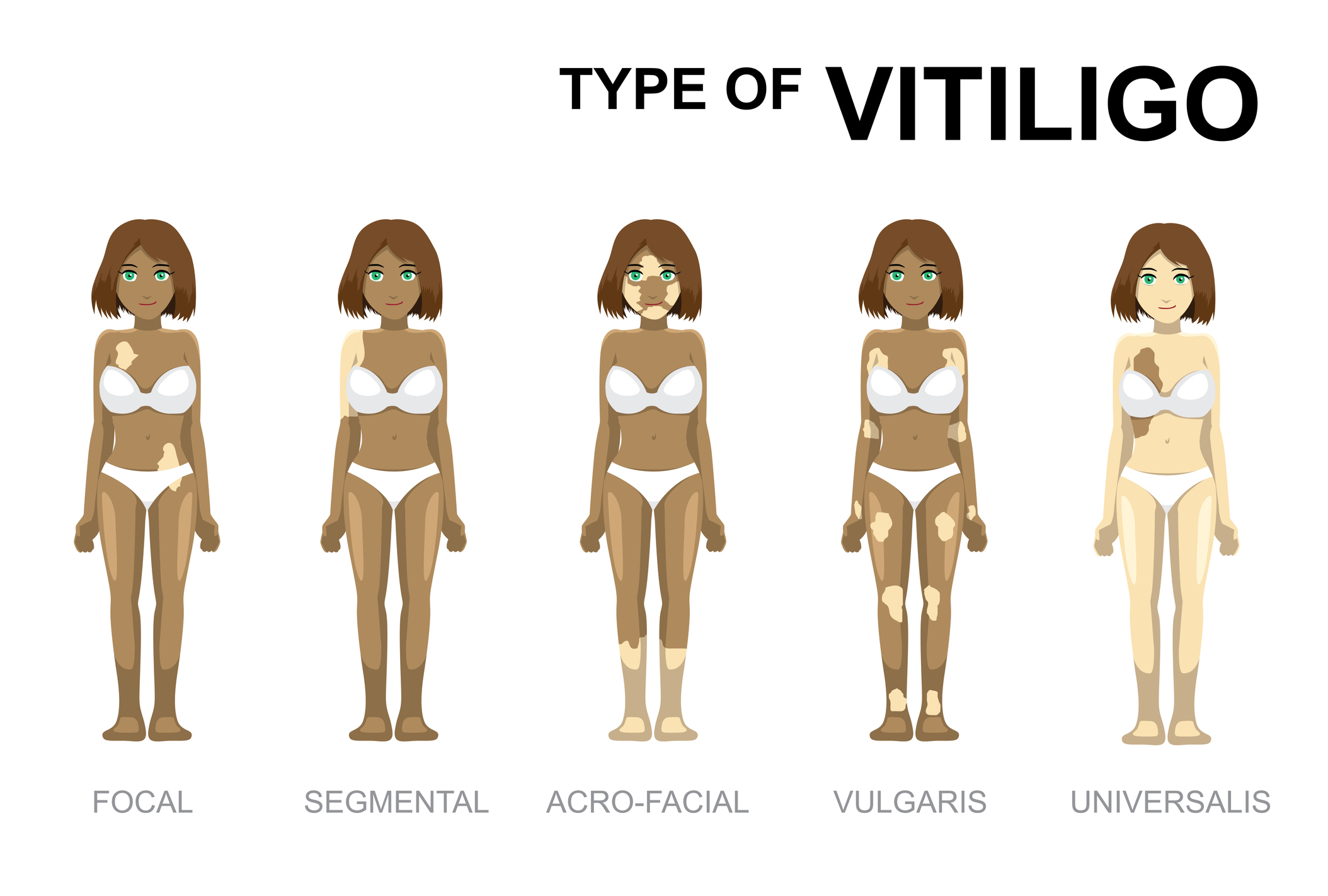 Vitiligo türleri