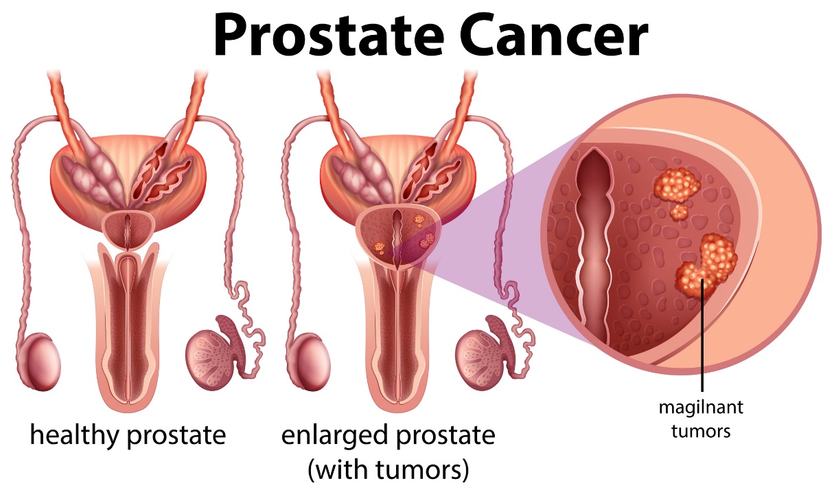 Prostat kanseri. Sağlıklı prostat ve tümörlü büyümüş prostat