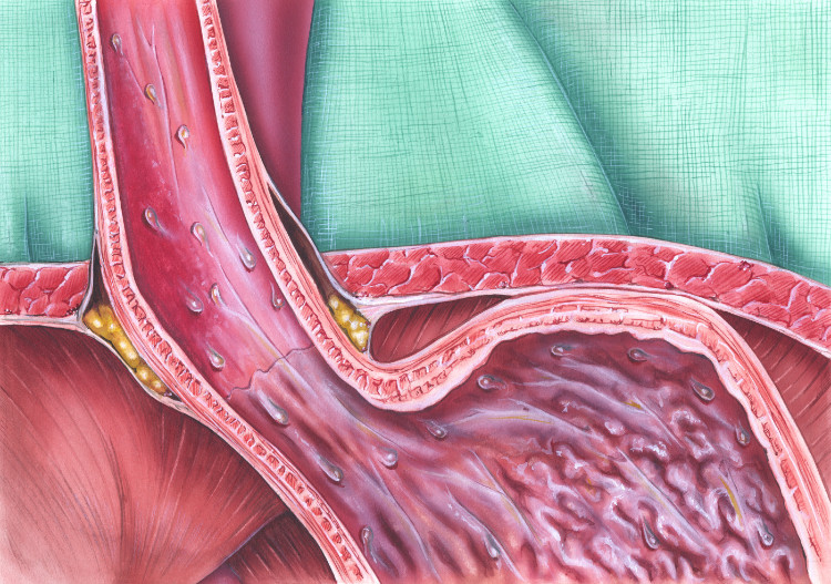 yemek borusu üzerinde anatomik olarak tasvir edilmiş sfinkter