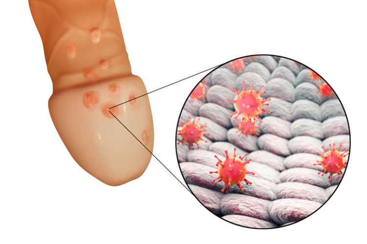 peniste genital herpes ve mikroskobik düzeyde herpes virüsü