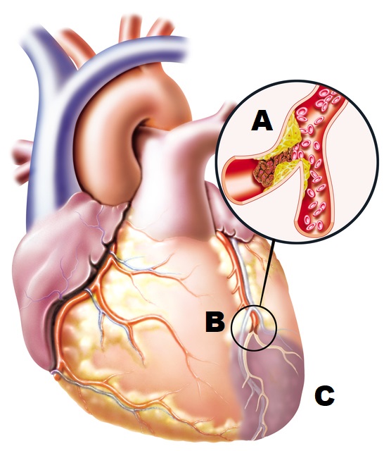 tıkalı bir kan damarı ile kalbin anatomik çizimi