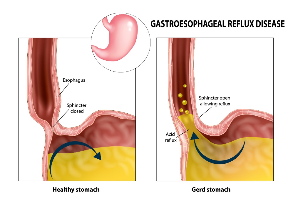 Gastroözofageal reflü: özofagus, sfinkter, mide ve mide asidi