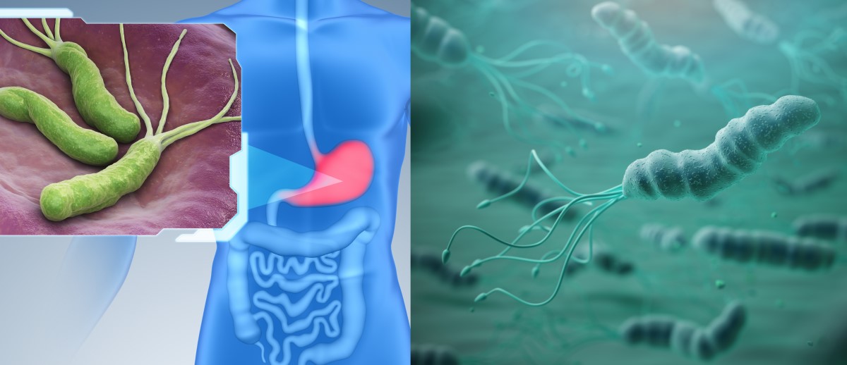 Helicobacter pylori mide zarında kolonize olur ve gastrit, ülser hastalığı ve kanser için bir risk faktörüdür.