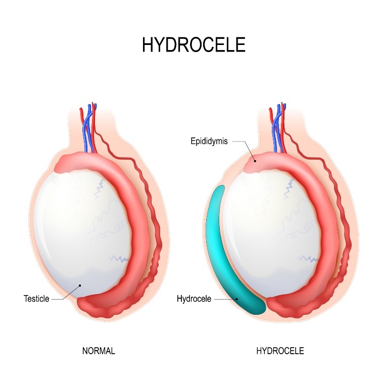 Hidrosel: testis, epididim, Hidrosel (birikmiş sıvı)