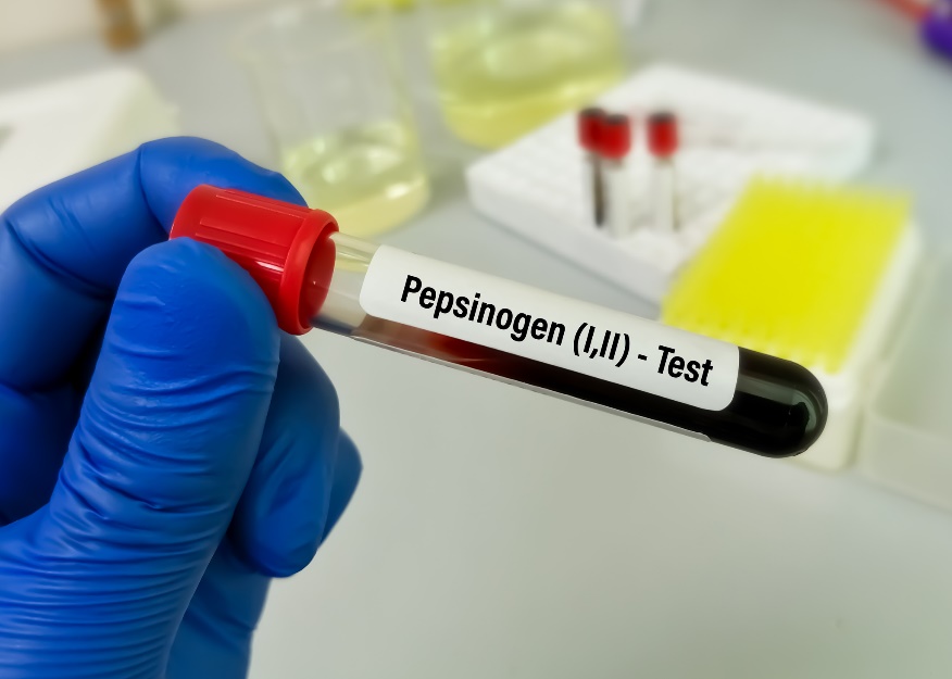 Pepsinojen seviyelerinin ve gastro hastalığın laboratuvar testleri için kan örneği