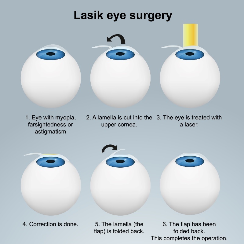 Lazer göz ameliyatı LASIK - yüzey altı yöntemi. Sinir uçlarına zarar vermeden flep/flap ile yapılan işlem.