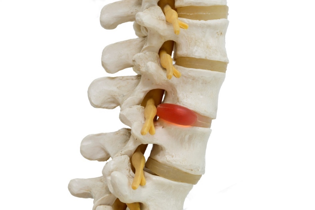 Omurganın, omurlar arası disklerin ve sinir sıkışması olan fıtıklaşmış diskin 3D modelinin anatomik gösterimi