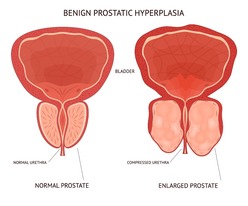 Prostatın iyi huylu (selim) büyümesi. mesane, prostat organının fizyolojik ve büyümüş dokusu.