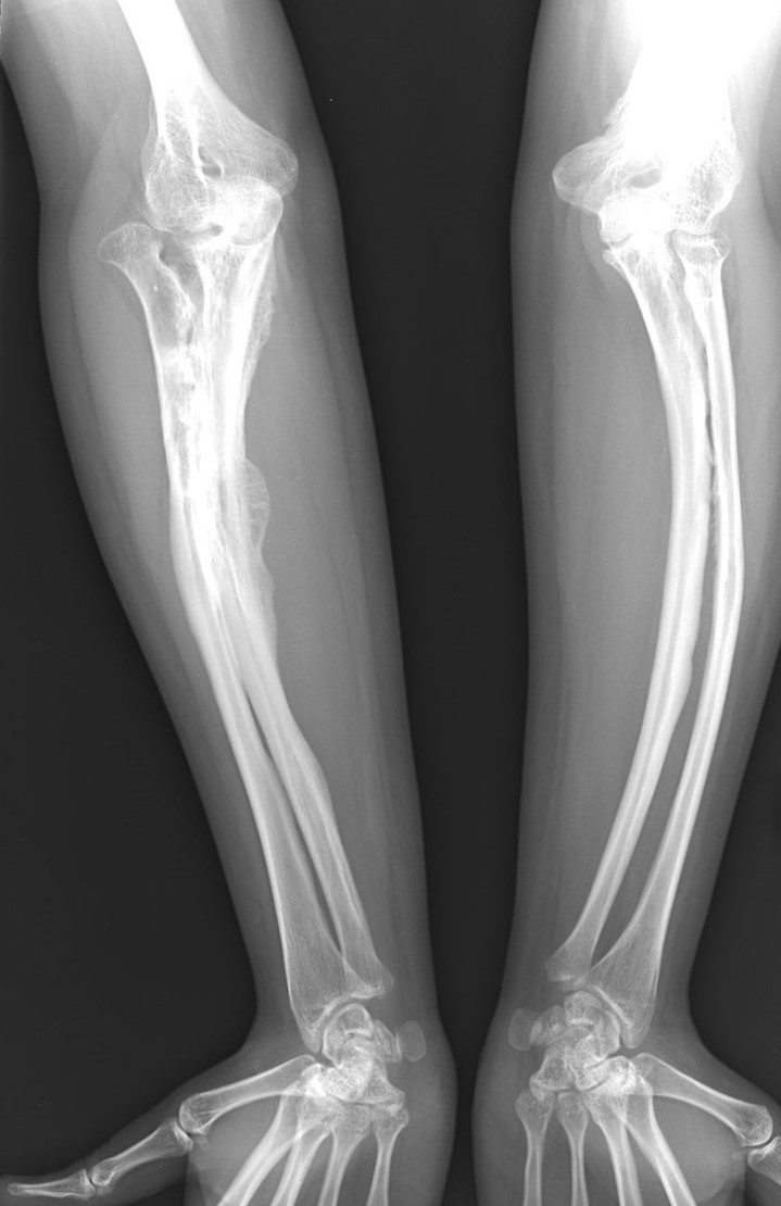 Bir yetişkinde osteogenezis imperfekta hastalığının radyografileri