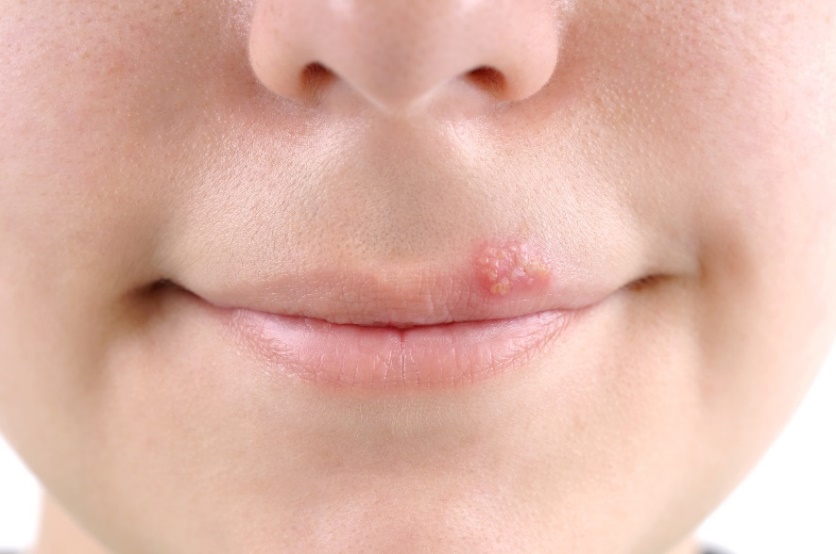 Kabarcıklar - ağız çevresindeki uçuklar (herpes).