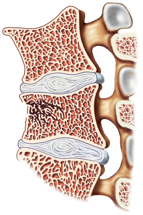 omurga, omurların ve intervertebral disklerin temsili, omur kırığı