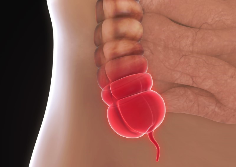 İltihaplı apandis modeli - anatomik görünüm