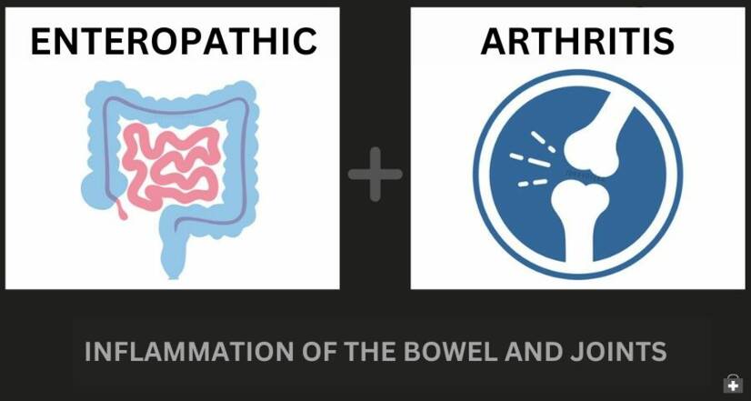 Enteropatik artrit ve inflamatuar bağırsak hastalığı: nasıl ilişkilidirler + Belirtiler