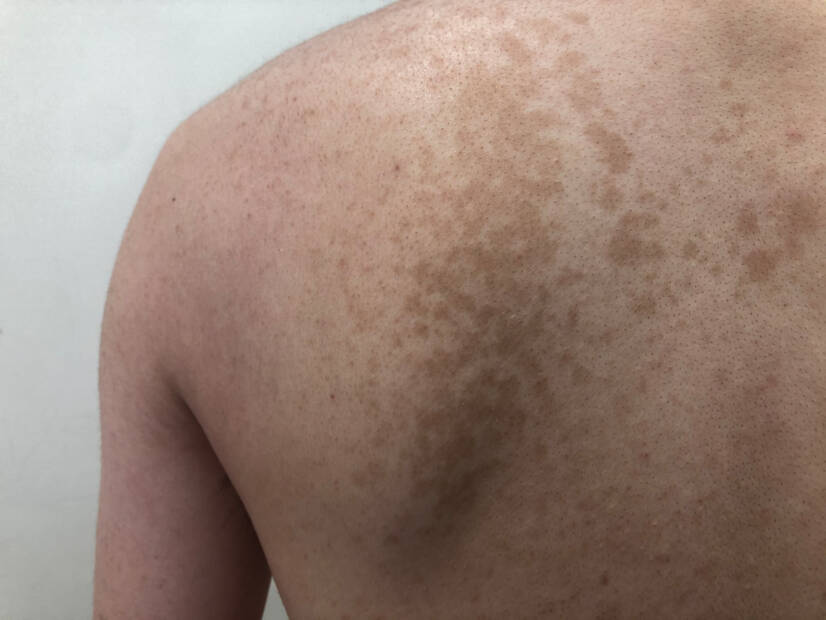 Pityriasis versicolor: Nedir ve hangi belirtilere sahiptir? Nedenleri ve bulaşması