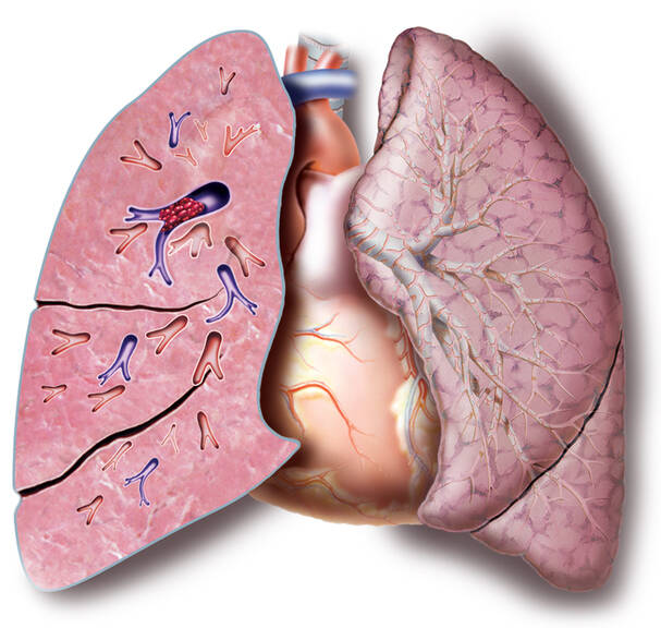 Pulmoner emboli: neden oluşur, nasıl ortaya çıkar, tespit ve tedavi edilir?