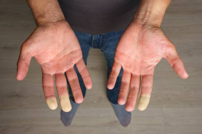 Raynaud sendromu: Parmak uyuşmasının nedeni nedir?