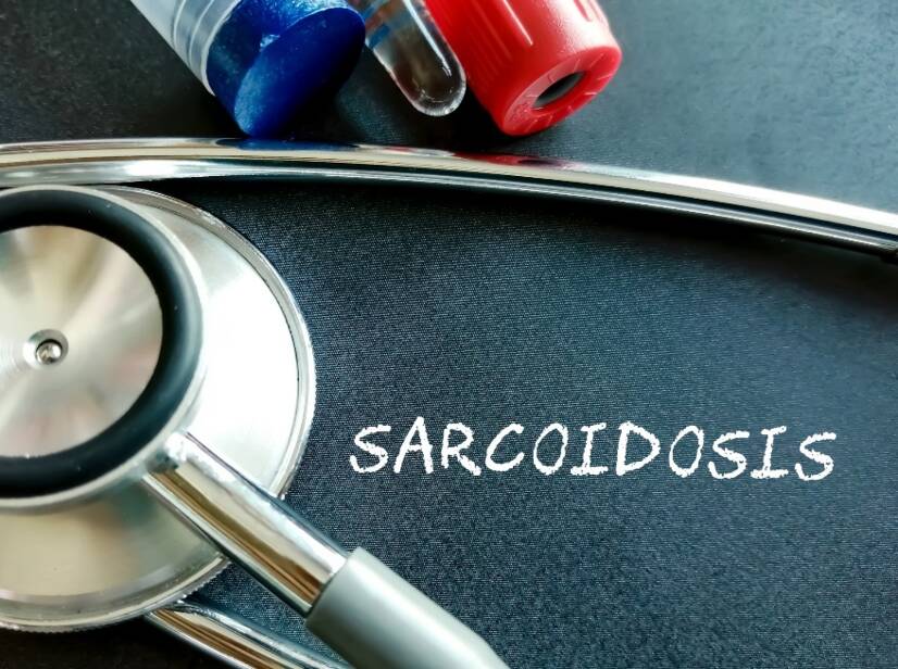 Sarkoidoz: Sarkoidoz nedir ve nedenleri/semptomları nelerdir? Pulmoner ve ekstrapulmoner formları