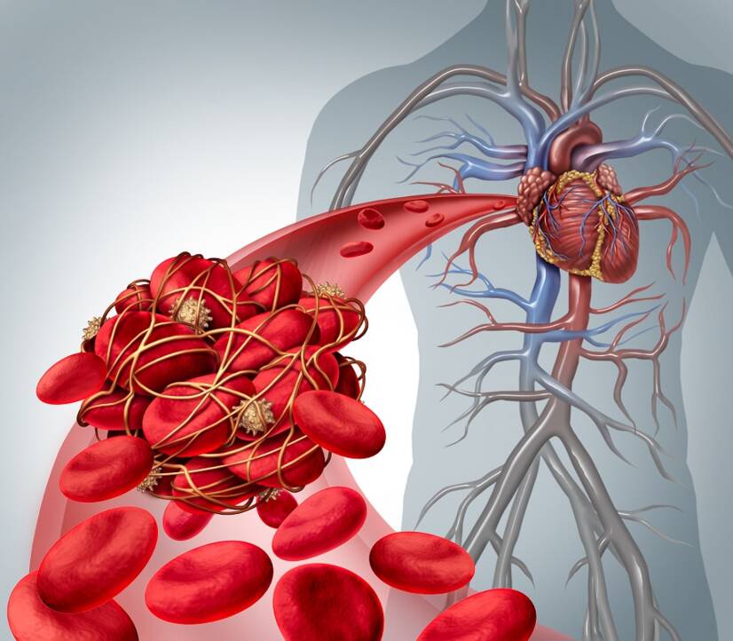 Tromboembolik hastalık, neden oluşur, pulmoner emboli ile nasıl ilişkilidir?