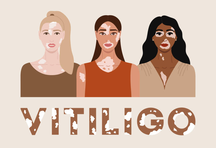 Vitiligo: Vitiligo nedir, nedenleri ve belirtileri nelerdir, ne zaman başlar?